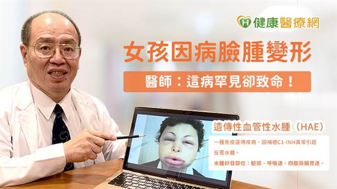 徐世达医师提醒，倘若民眾有反覆性的血管性水肿、反覆性的腹痛、具有喉头水肿病史或是家族血管性水肿病史等状况，都要提高警觉。(图/健康医疗网提供)