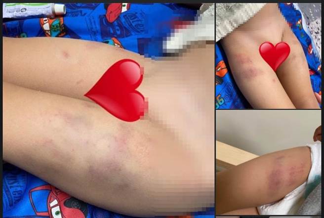 一名男童因想帮忙清洁同学呕吐物，遭到园长捏大腿捏到瘀青。（撷自靠北恶质幼儿园脸书／邱立雅竹市传真）