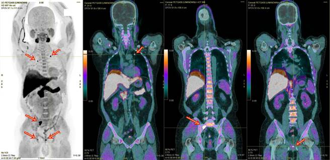 奥摄敏全身正子影像检查，精准找出48岁患者摄护腺肿瘤与转移至肺与骨之肿瘤，各种不同角度之检查影像，红箭头为肿瘤处。（梧栖童医院提供）