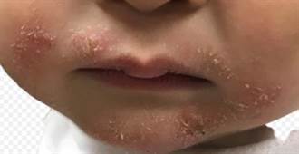營養素鋅缺乏 10個月大男嬰嘴巴周圍長紅疹、生長遲滯