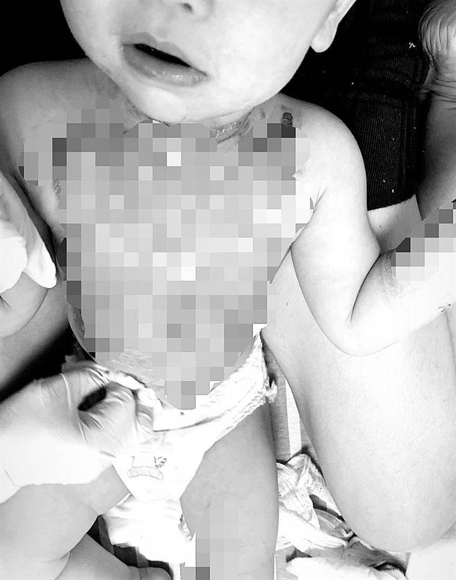 女婴前胸至腹部大面积脱皮、红肿。（民眾提供／陈彩玲基隆传真）