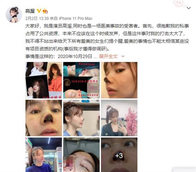 高溜自曝整形失敗。(圖／翻攝自微博)