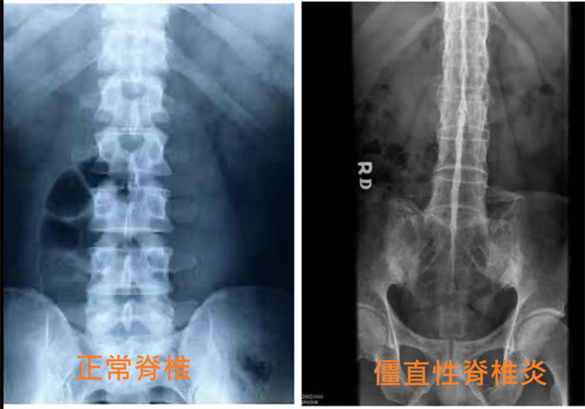 有护理师网友PO出X光片，解答脊椎一整条烧不掉的真相。（翻摄 脸书 BigBrother大师兄粉专）
