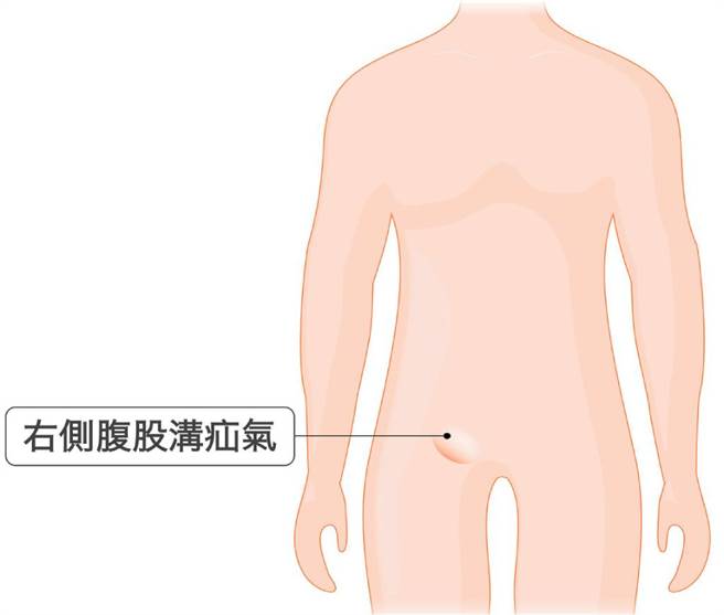儿童腹股沟疝气绝大多数是间接型疝气，是一种先天性疾病。(图/台北荣总提供)