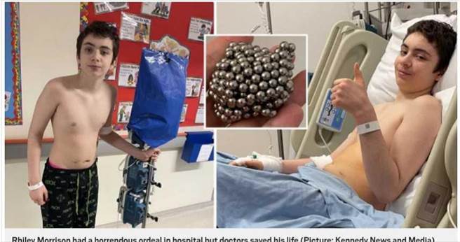 英国男童吞食54颗磁性球实验，结果被送到医院进行紧急手术。（图／翻摄自地铁报）