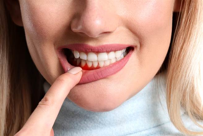 一項跨國研究顯示，罹患牙周病的新冠患者死亡率較其他患者高出9倍。（示意圖／shutterstock）