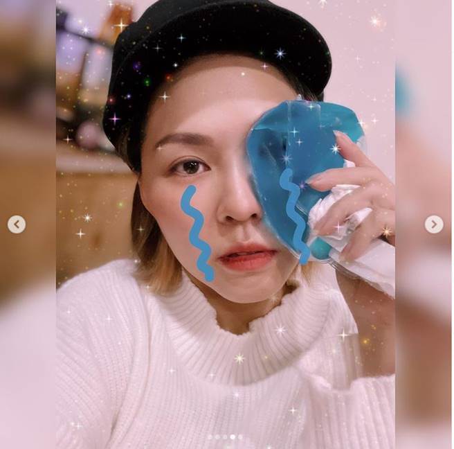 熊熊摔倒导致脸肿、眼瘀青，而她今天凌晨则晒出自拍近照，让伤势全曝光。（图／取材自熊熊Instagram）
