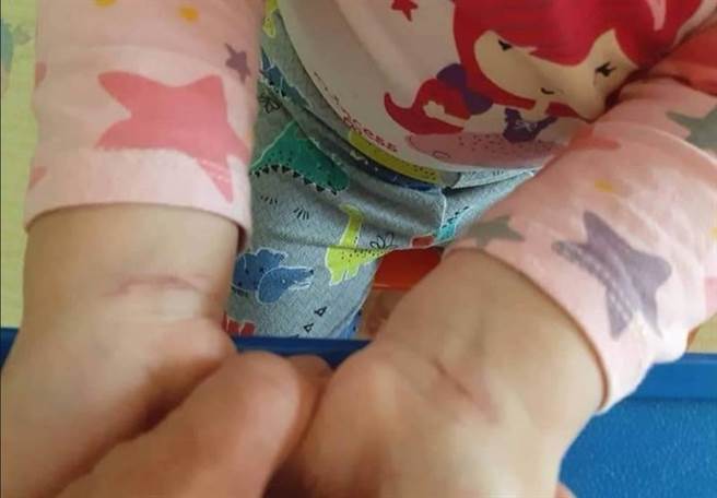 女童双手手腕有勒痕。（家长提供／曹婷婷台南传真）