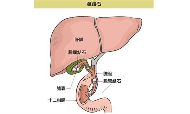 什么是胆结石?（图片来源/康健资料库提供）