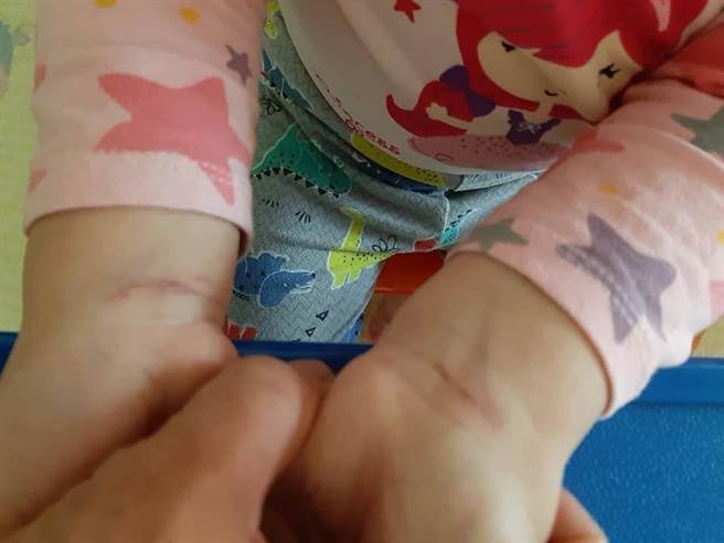 女童雙手手腕有不明勒痕。（家長提供／曹婷婷台南傳真）