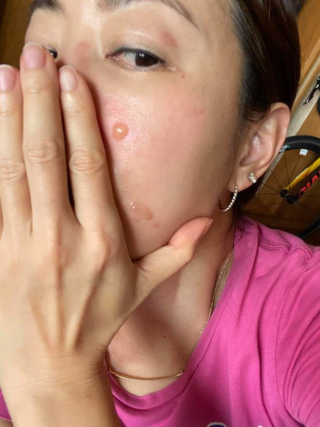 賈永婕被燙出好幾個水泡。（圖／翻攝自臉書）