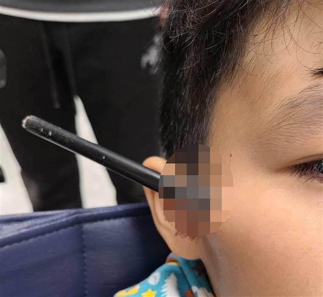 7歲的林小弟弟意外遭金屬箭頭涉入臉部，所幸在衛生福利部南投醫院急救後，箭尖未傷及眼睛或顏面神經，男童在安排手術移除異物與清創後，已無大礙。（部立南投醫院提供／黃立杰南投傳真）