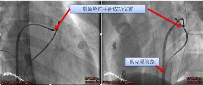 新竹台大分院新竹醫院為竹苗地區唯一全時間待命的葉克膜照護團隊，成功保住21歲男子性命。圖為電氣燒灼手術成功位置圖。（新竹台大分院提供／邱立雅竹市傳真）