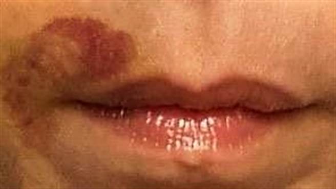 李翊君脸部瘀青牙龈出血。（艾迪升提供）