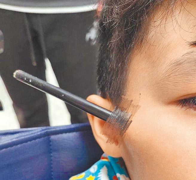 7歲的林小弟弟意外遭金屬箭頭涉入臉部，所幸在衛生福利部南投醫院急救後，箭尖未傷及眼睛或顏面神經，男童在安排手術移除異物與清創後，已無大礙。（部立南投醫院提供／黃立杰南投傳真）