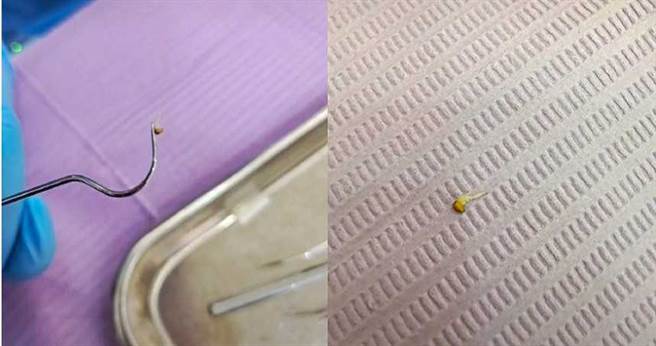 陆女到医院拔牙 医生竟挖出已经发芽草莓籽(图片取自/我与老公的日常微博)