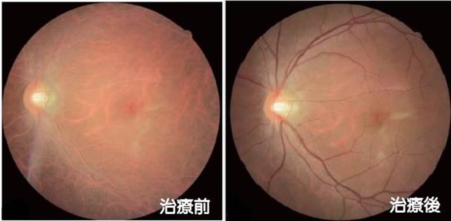糖尿病容易併發視網膜病變，檢查時發現油脂塞滿了血管原本應是紅色的血管已變成亮黃色。(左)治療前：油脂塞滿了血管；(右)治療後：眼底血管中的油脂改善，血管恢復通暢。（大甲李綜合提供／陳淑娥台中傳真）