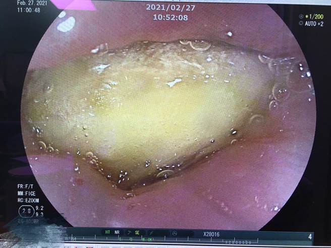李姓男子大口吞鳳梨，結果卡在食道。（南投醫院提供／廖志晃南投傳真）