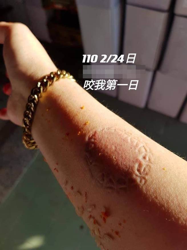 李姓前空姐发文指控婆婆失控咬上她手臂，留下明显齿痕。（摘自脸书「爆料公社」）