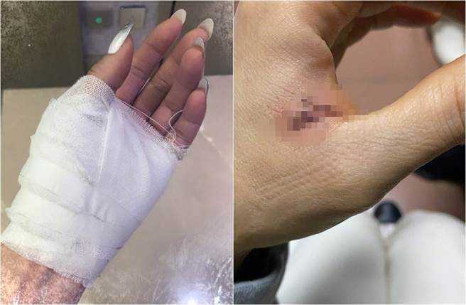 容祖儿伤势照惊悚。(取材自容祖儿微博)