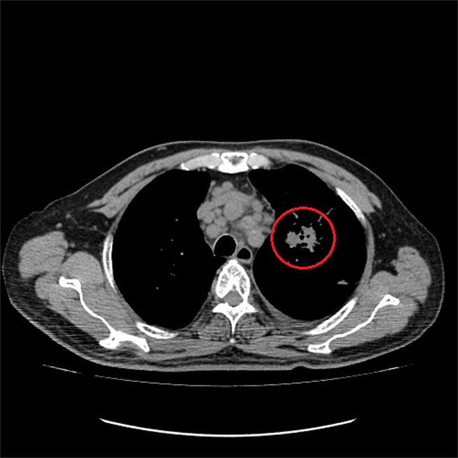 治疗六个月肺腺癌已明显缩小到3公分。（台中澄清医院提供／冯惠宜台中传真）
