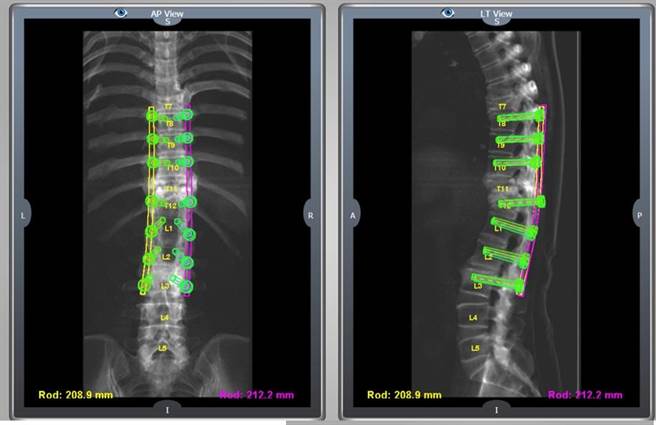 雷纳生脊椎机械手臂大幅增加钢钉植入精准度，减少神经伤害风险。（光田综合医院提供／陈淑娥台中传真）