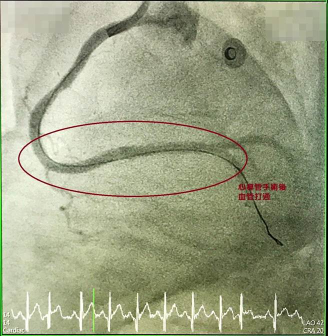 心导管手术后(血管已打通)。（大甲李综合医院提供）