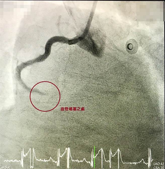 心導管手術前(血管堵塞)。（大甲李綜合提供／陳淑娥台中傳真）