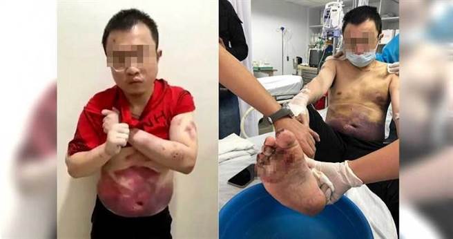 博弈集团不允许阿明离职，遂对他施以鞭刑、水刑、拿菸头烫他全身，甚至将他的脚掌淋酒精后再点火。（图／读者提供）