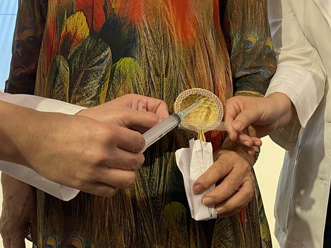 治疗混合型的尿失禁可透过微创「尿道中段吊带手术」治疗应力性尿失禁，以及採「肉毒杆菌素膀胱内注射」改善急迫性尿失禁，并经术前仔细评估，採二合一手术，毕其功于一役。（冯惠宜摄）