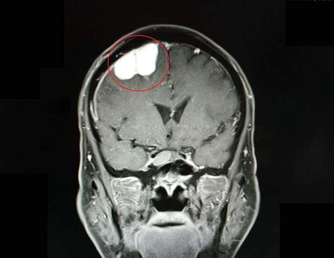 老翁因走路不穩跌倒就醫，檢查竟發現有3公分腦瘤(紅圈處)。（大千醫院提供／何冠嫻苗栗傳真）
