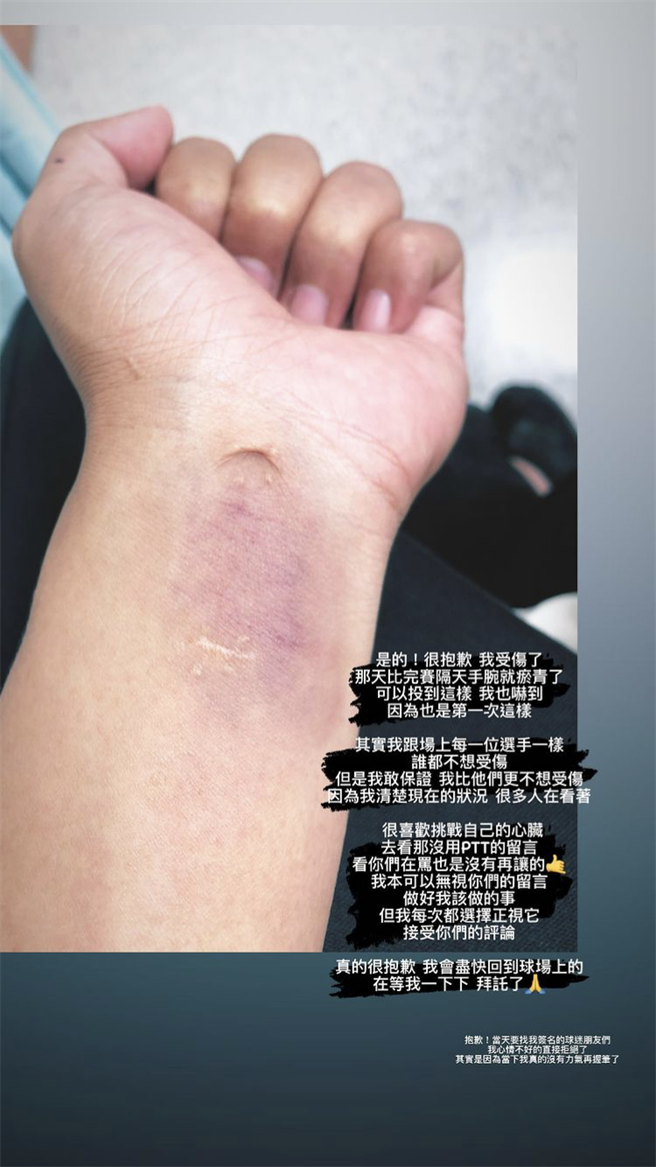 王維中在個人社群平台上貼出自己手腕瘀青的照片。（截自王維中個人Instagram）