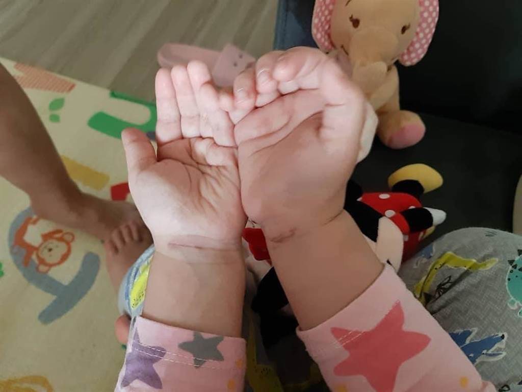 台南一名彭姓女子2月控訴幼兒園虐童，導致2歲女兒手腕被勒傷，圖可見手腕處有線形傷痕。（中時資料照）
