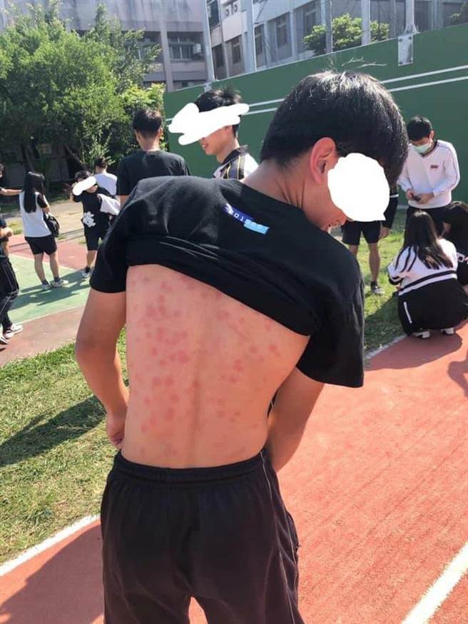 男同学掀起衣服，秀出后背满布被射击的红点。（摘自爆料公社）