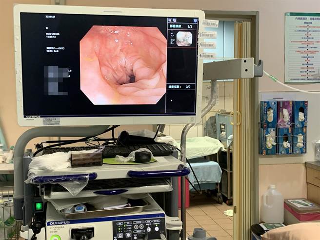 戴男有痔疮问题，认为上厕所出现血便、粪便形状变细等症状为正常，经大肠镜检查后发现，右侧大肠有扁平型息肉，并被确诊为第一期升结肠癌。（门诺医院提供／罗亦晽花莲传真）