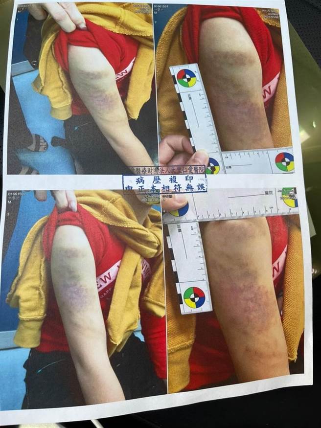 10岁林姓学童连喊3声老师后，突发性情绪失控，连续毒打该名学生近10下，造成大面积瘀伤。（市议员郑功进服务处提供）