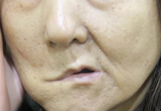 彰化县员林市1名56岁张姓妇人，2年前突然顏面失调眼歪嘴斜，右半张脸几乎不能动弹，右眼也无法闭上，求诊当成顏面神经麻痹治疗，没想到经过2年仍未痊癒，最后求诊署立彰化医院才发现是腮腺癌。（彰化医院提供／吴建辉彰化传真）