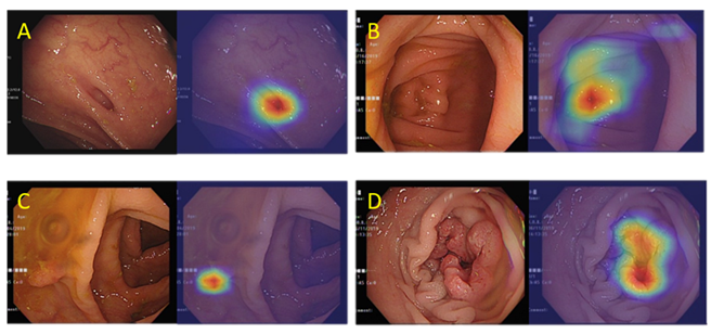 利用人工智慧系統自動判定病灶位置，可以分別找出（A）大腸憩室、              （B）盲腸、（C）大腸瘜肉及（D）癌症病灶的位置。(圖/台北榮總提供)