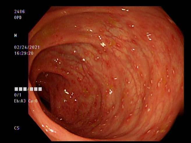 透過大腸鏡影像檢查，可發現該名患者腸道有白色點點的阿米巴原蟲感染。（亞大醫院提供／林欣儀台中傳真）