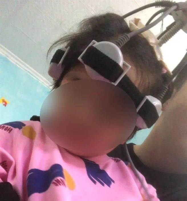 3岁女童喝了1年多「金大洋贝儿康」后，出现了身体和智力发育迟缓的情况，目前已被医院判定为2级智力残疾。图为女童接受脑循环治疗。（图／网路）