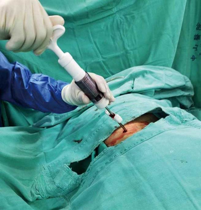 EVA微創手術造成的傷口僅約0.5公分，患者術後復原快，較為便利。（圖／李炫昇提供）