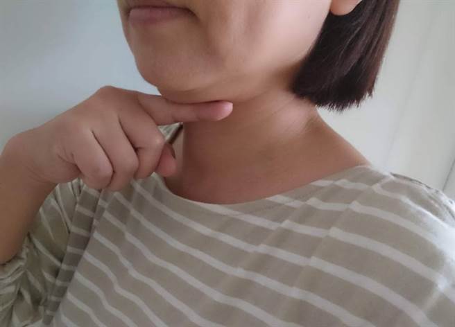 双下巴坏处再添一桩 研究：心血管在拉紧报。(示意图/本报系资料照片)