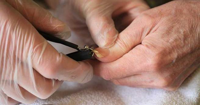 只是剪指甲，竟然嚴重到要截肢。（示意圖／翻攝自Pixabay）