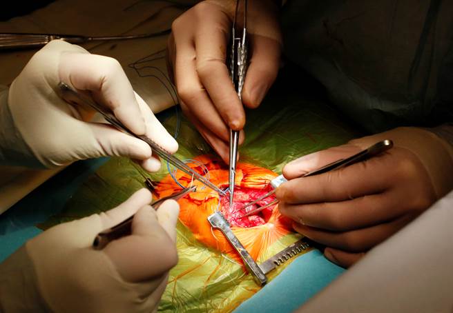 加国研究团队证实，大量摄取精制谷物会提升心肌梗塞、心臟衰竭、中风等的风险，连带地死亡率也上升。图为心血管手术。(图/路透社)
