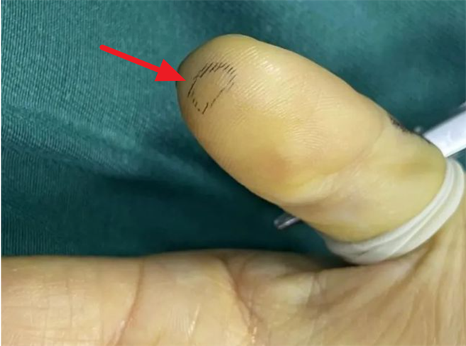 手机保护贴碎片刺进手指伤及骨头，伤口痊癒却长出神经瘤。（翻摄 网易新闻）