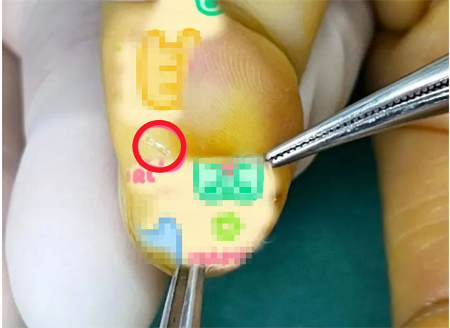 手术后医生在伤口处取出了一块极微细小的保护贴碎片。（网易新闻）