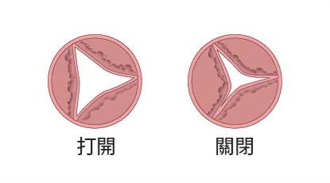 主動脈瓣膜狹窄。（國泰醫院提供）