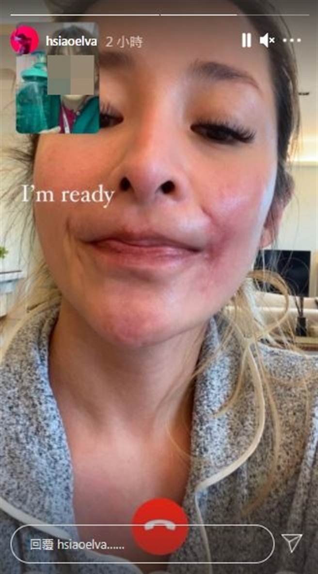 萧亚轩首曝脸上伤疤。（图／翻摄自IG）