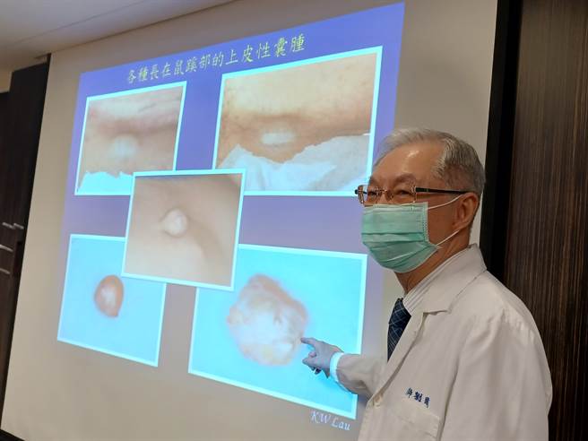 书田诊所整形美容科主任医师刘国威表示，在鼠蹊部发现肿块有30％是恶性肿瘤转移造成，因此民眾一旦在鼠蹊部发现肿块且外观有变化时，就应积极就医。（林周义摄）