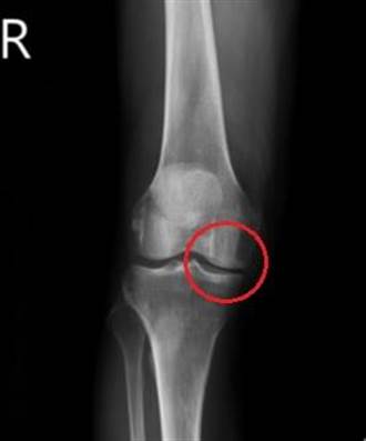 早期膝關節炎換半套人工關節 8旬翁重拾鐵馬樂